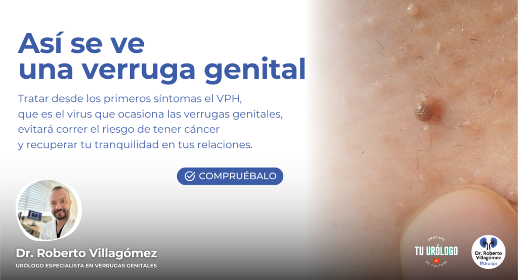 Urologo especialista en verrugas genitales Queretaro