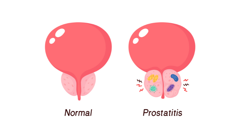 Urologo especialista en prostatitis Queretaro
