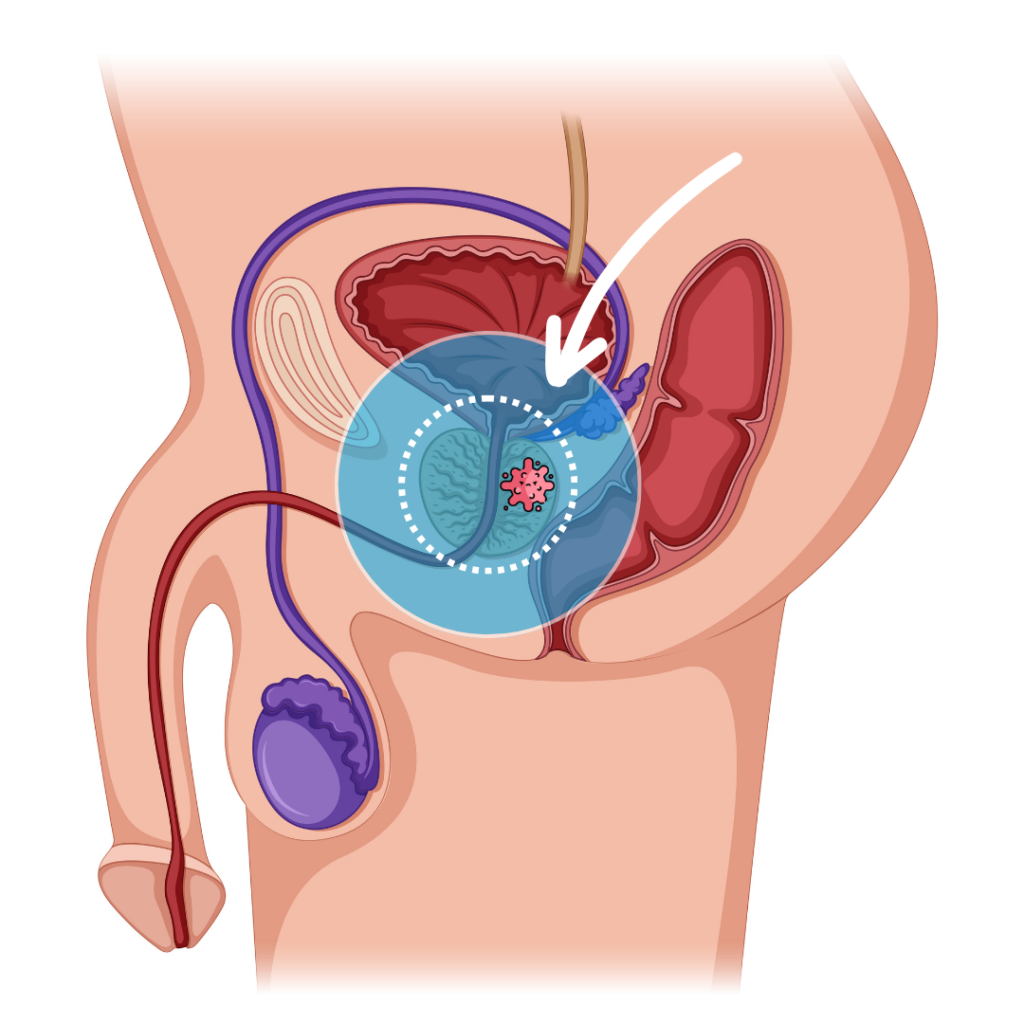 Tratamientos de cancer de prostata en Queretaro